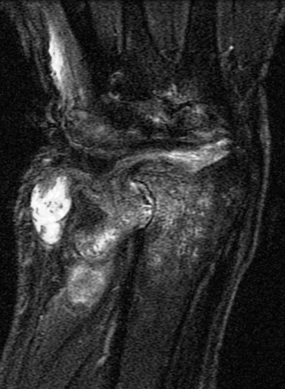 Figure 5 for case Rheumatoid arthritis ( RID3561 )
